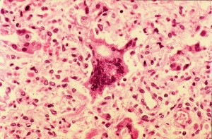 Histopathology of Measles Pneumonia