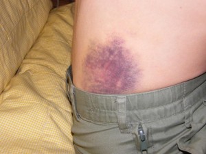 Wormster Shows His Wounds